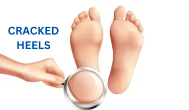 CRACKED HEELS 1 min How to Fix Cracked Heels Permanently at Home