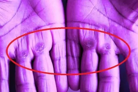 colluses hand How to Get Rid of Calluses on Hands Overnight: 5 Supreme Home Remedies