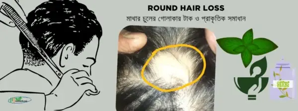 Round Hair Loss