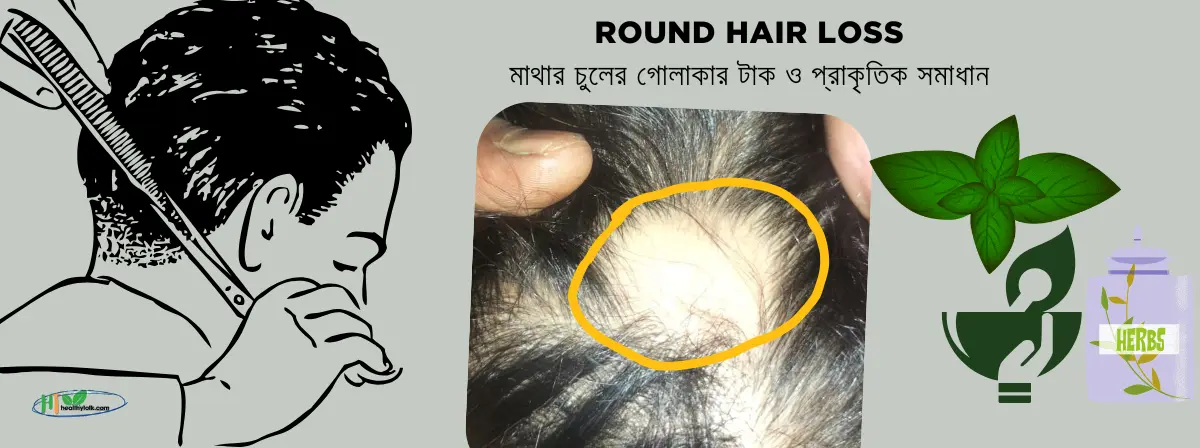 Round Hair Loss