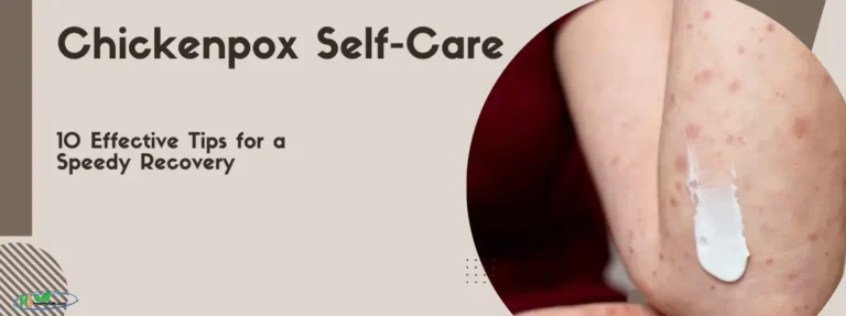 Chickenpox Self-Care 10 Effective Tips for a Speedy Recovery