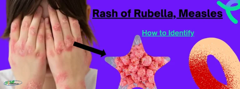 Rubella Rash vs Measles Rash